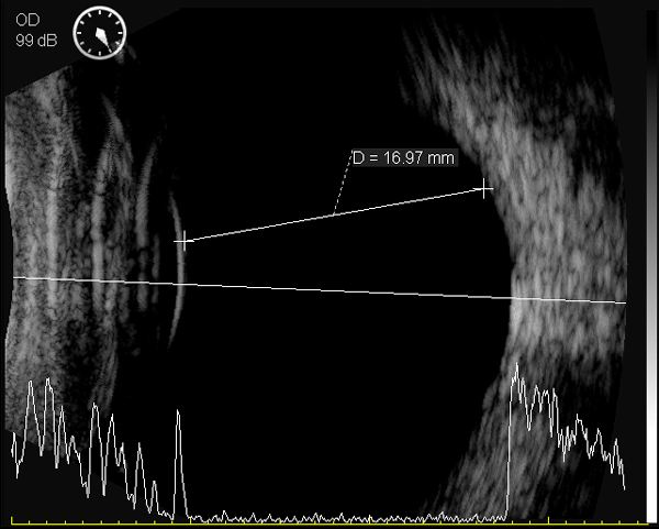 ultrasound eus-2600 ezer - us ophthalmic